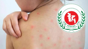 হাম ও উপসর্গে মৃতের সংখ্যা বেড়ে ৬৪৩