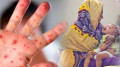 হাম উপসর্গে আরও পাঁচ শিশুর মৃত্যু, একদিনে আক্রান্ত ১৪১১