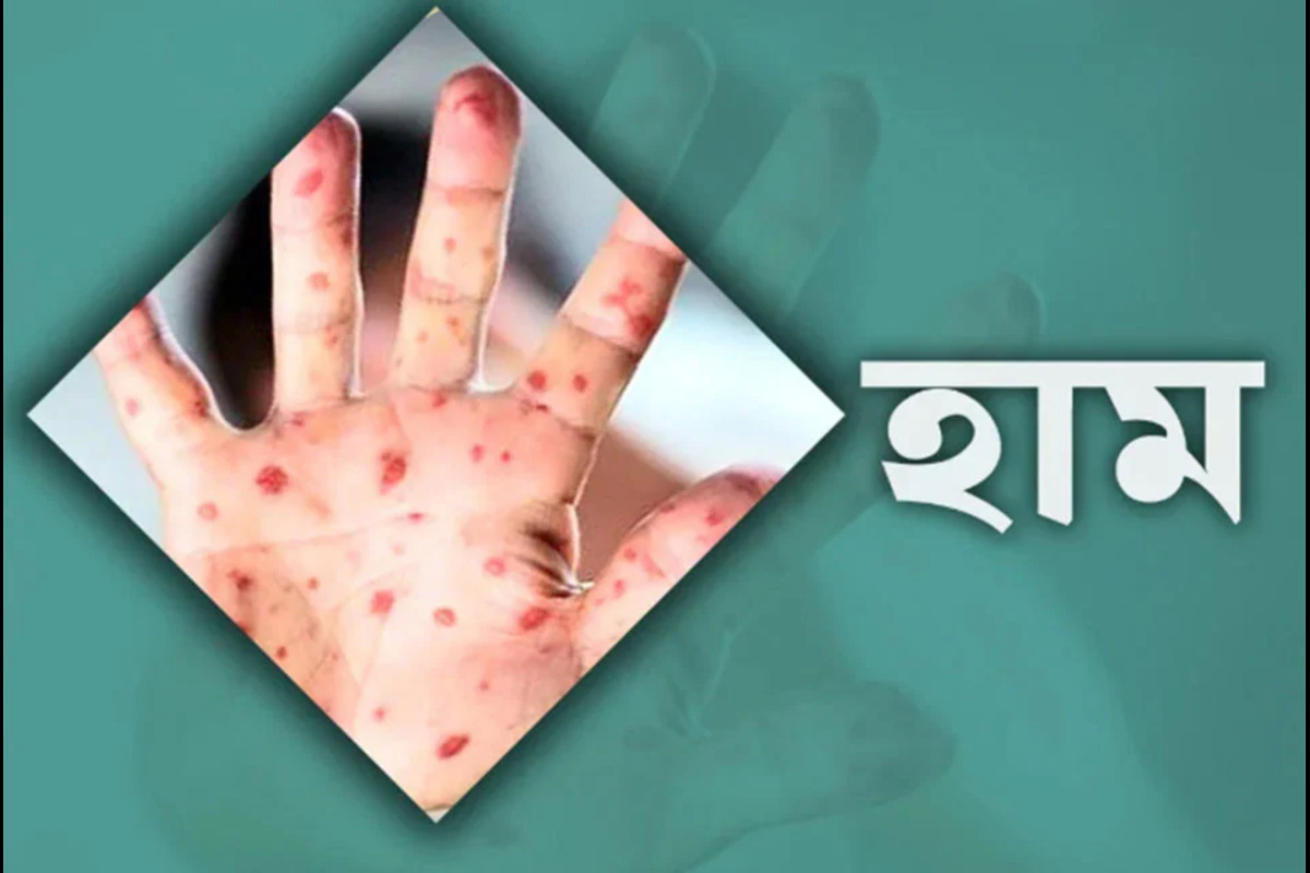 হামের উপসর্গে একদিনে ৫ জনের মৃত্যু